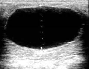 Ultrasound image of a dominant follicle.